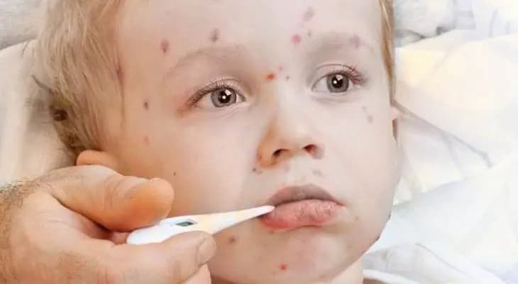 العالم يواجه خطر تفشي الحصبة بسبب تعطل تطعيم الرضع