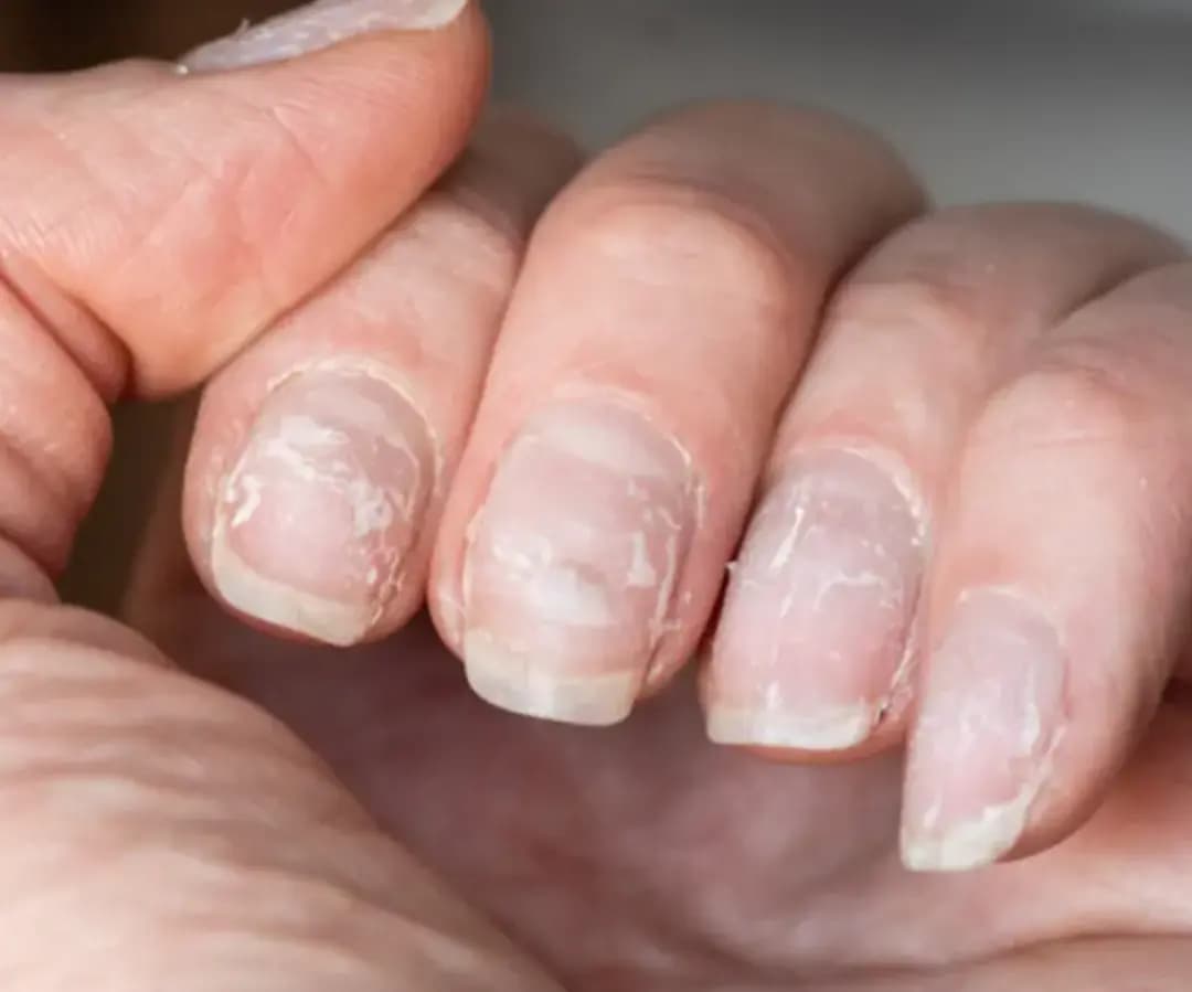 العلامات البيضاء على الأظافر: تعرّف على الأسباب وسبل العلاج والوقاية